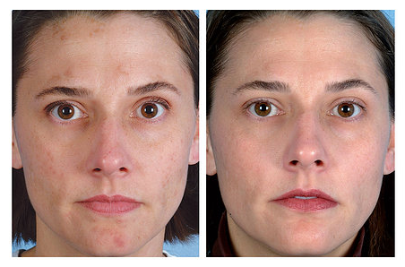 Fotó: lézeres pigmentfolt kezelés előtt, és 25 nappal utána 