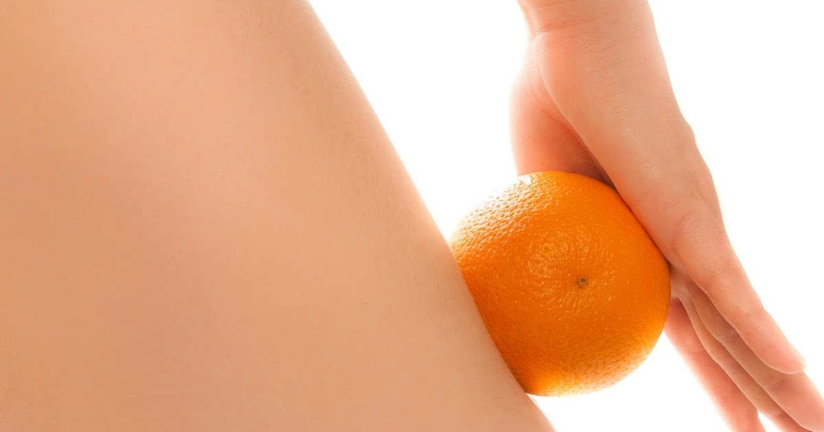 Cellulit-GYIK: 5 tévhit a narancsbőrről