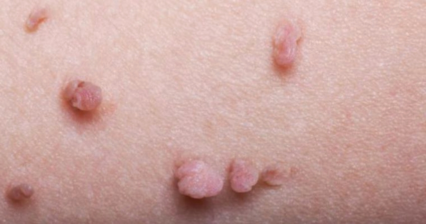 Szemölcsök és HPV – a bőrgyógyász válaszol